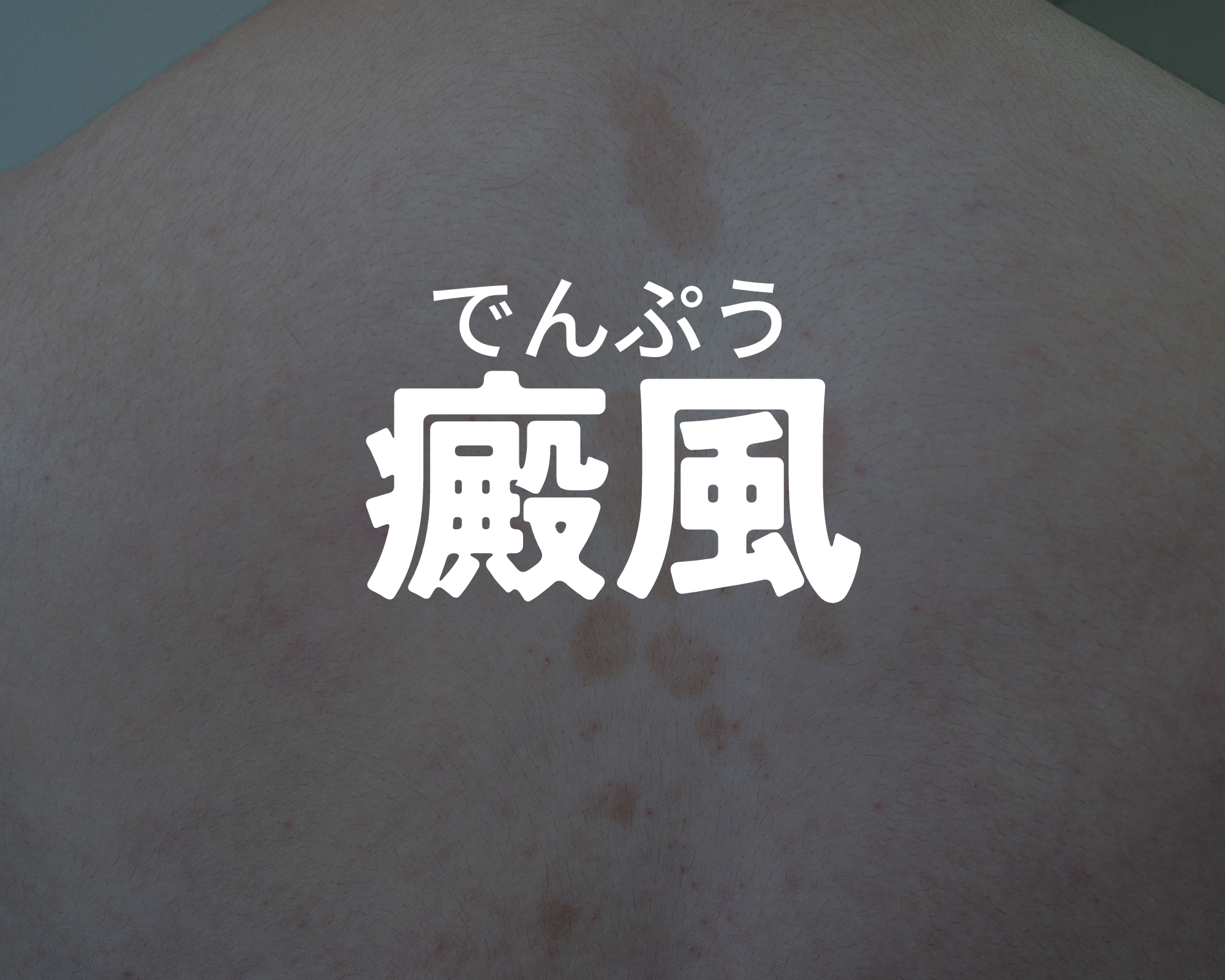 【夏季に多い】 癜風(でんぷう)について【皮膚科専門医が解説】 | 浦和駅前すずき皮膚科